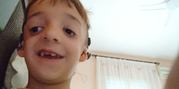Pablo, niño con Síndrome Treacher Collins