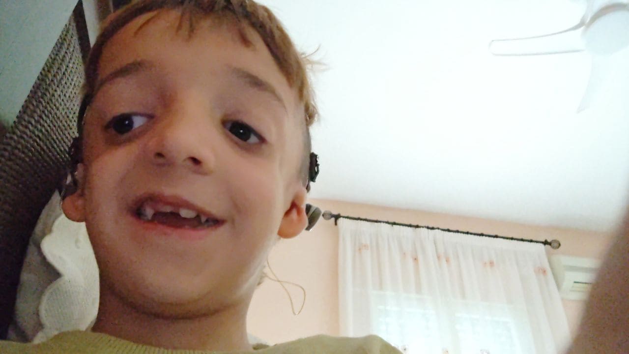 Pablo, niño con Síndrome Treacher Collins