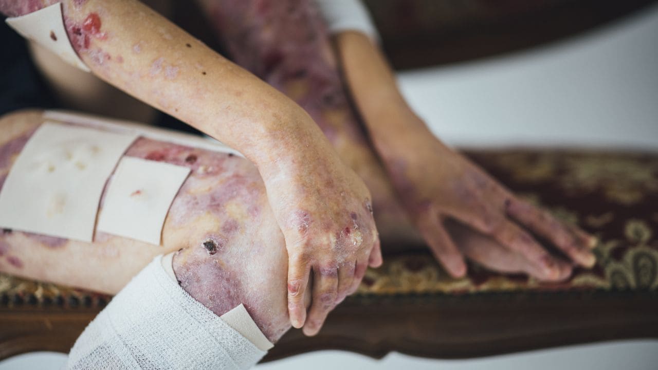 Descubren una cura para la enfermedad de piel de mariposa