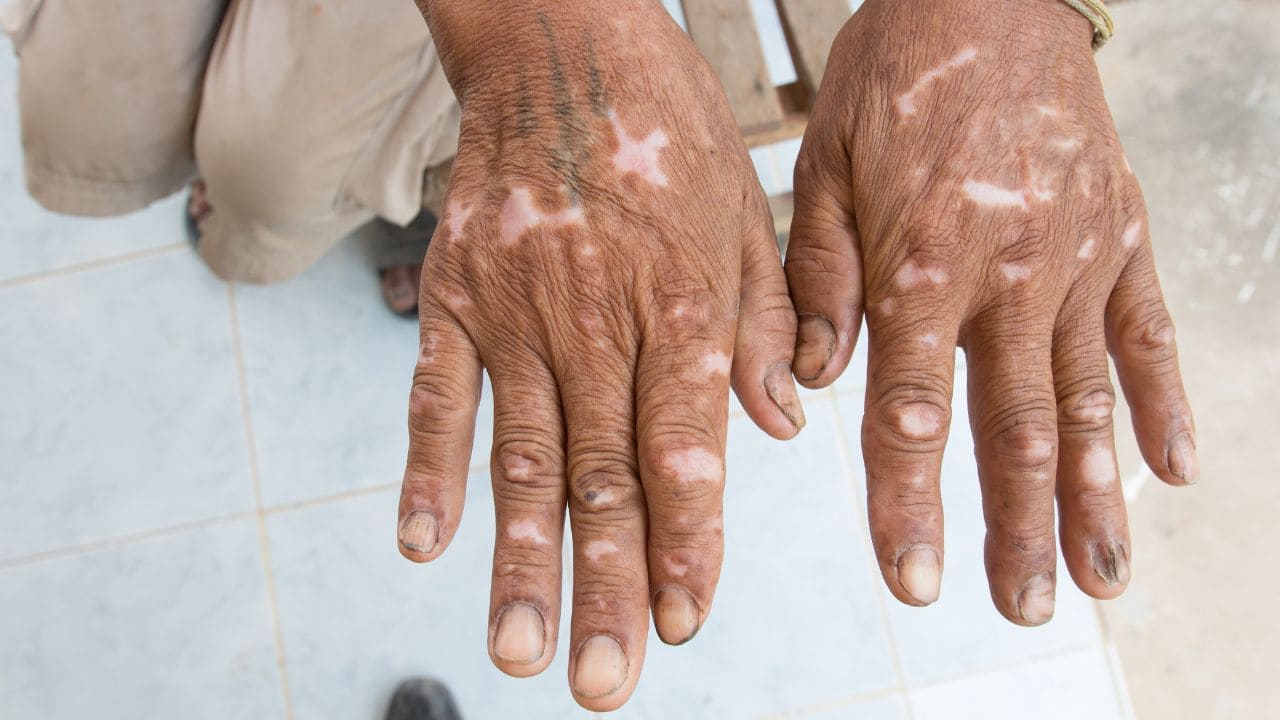 Jubilación anticipada por esclerodermia