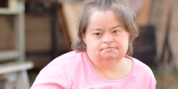 Alzheimer en personas con síndrome de Down mayores de 65 años