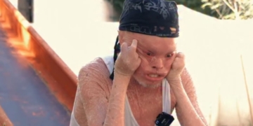 Alejandro, joven con ictiosis arlequín