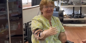 María Isabel vuelve a 'tener' brazos gracias a 'Ayudame3d'