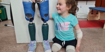 Ángela, marcada por una sepsis por meningococo desde los seis años: resiliencia, inclusión y amor propio