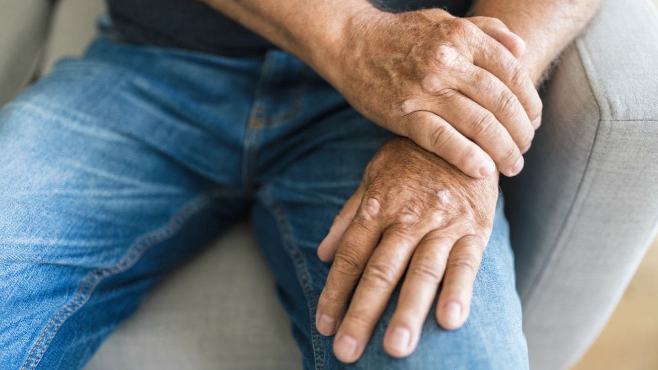 Incapacidad permanente por artritis psoriásica