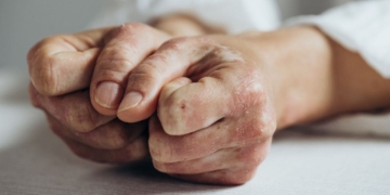 Incapacidad permanente por artritis psoriásica