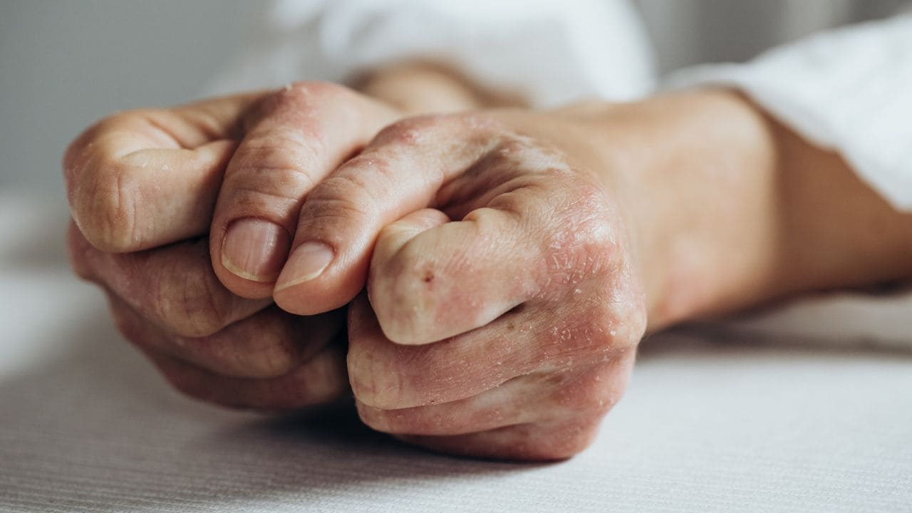 Incapacidad permanente por artritis psoriásica