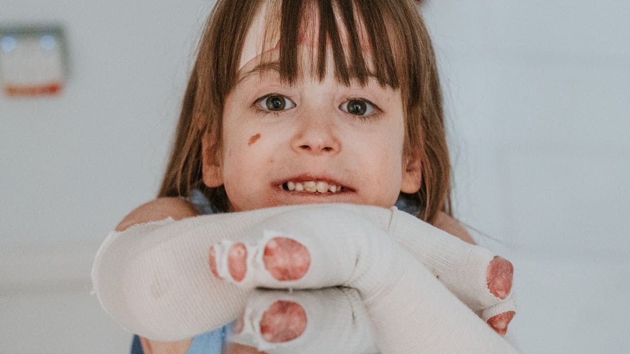 Vyjuvek, un medicamento contra la Piel de Mariposa que reclaman en España: "Esperar no es una opción"