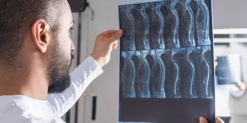 El trasplante de células mejora la salud cardiovascular tras una lesión medular./ Licencia Adobe Stock