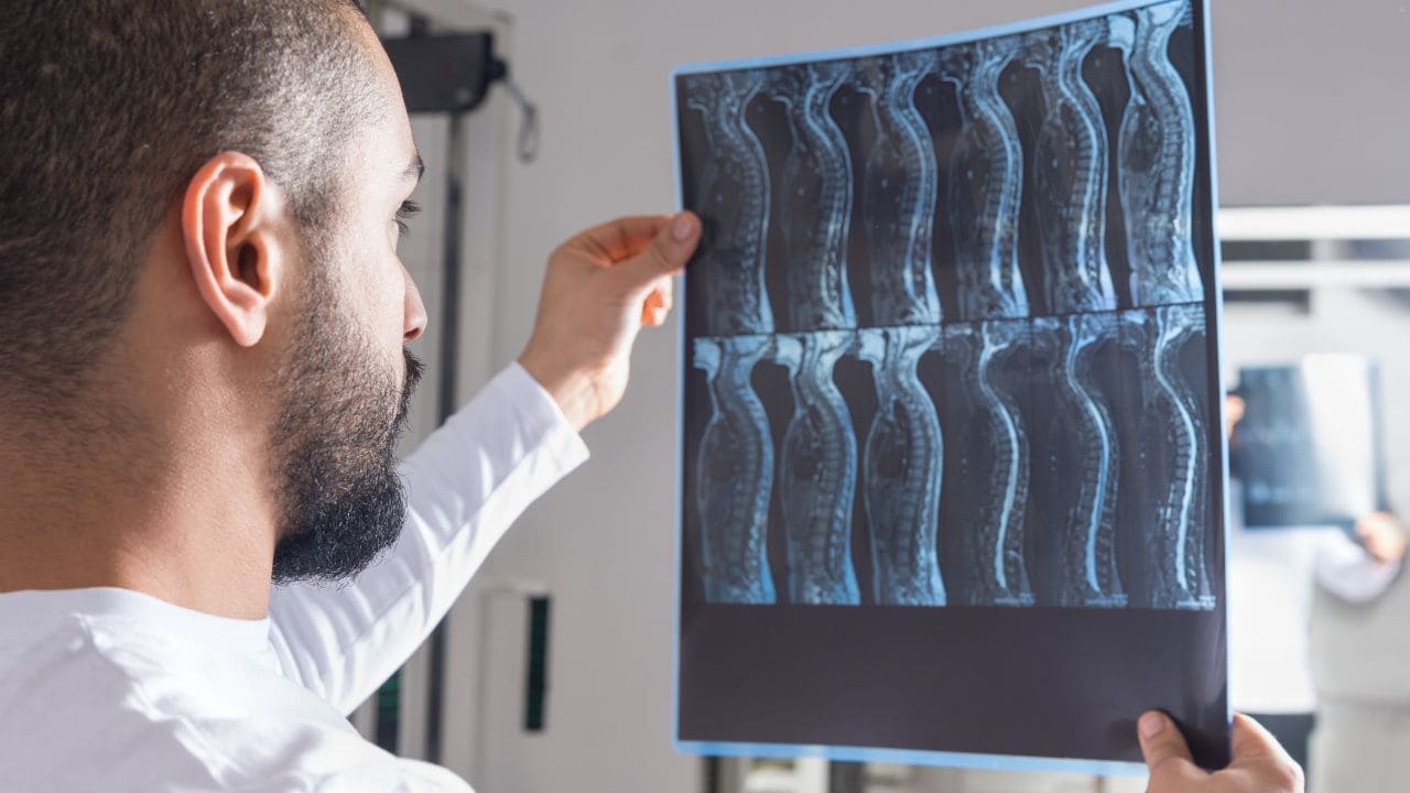 El trasplante de células mejora la salud cardiovascular tras una lesión medular./ Licencia Adobe Stock