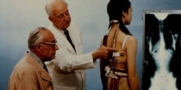 El corsé 'Milwaukee' cumple 80 años ortopedia