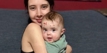 Ana Domenech, madre de una niña con Piel de Mariposa: "Ninguna de sus heridas le quita las ganas de vivir"