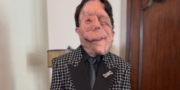 Adam Pearson visibiliza su enfermedad rara en la alfombra roja de la gala de los Premios Oscar