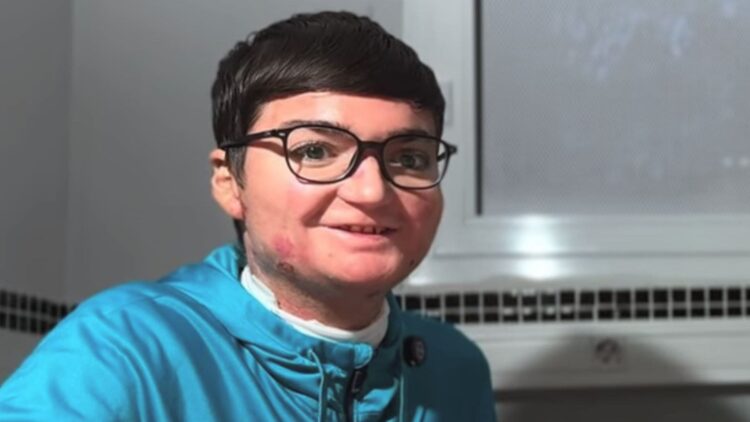 Adrián Soto, joven con Piel de Mariposa