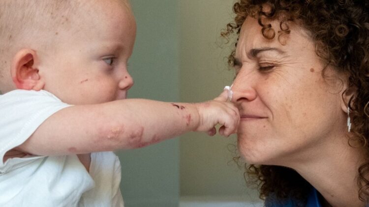 'Vyjuvek', el innovador tratamiento para la Piel de Mariposa: "Ayuda a cerrar heridas, pero no es una cura definitiva"