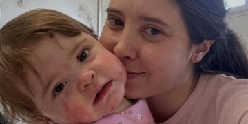 Ana Domenech, divulgadora y madre de una niña con Piel de Mariposa