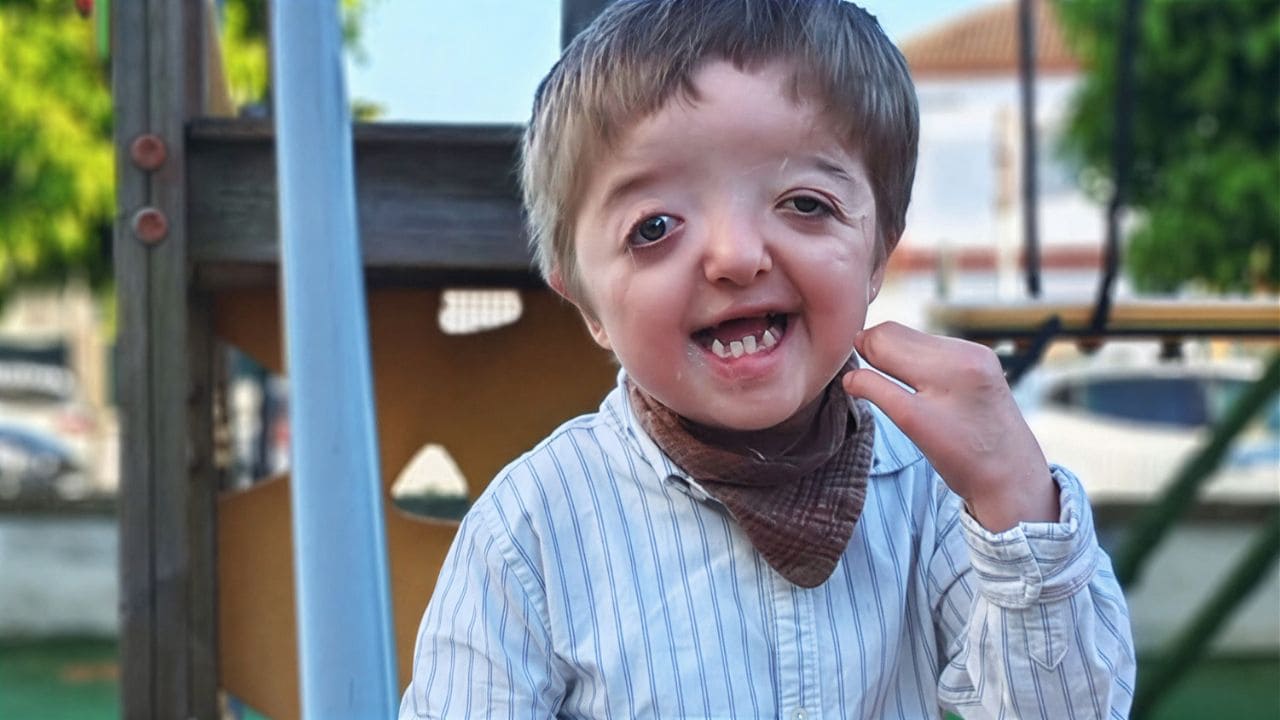 Así es vivir con craneosinostosis: «Porque concienciar también salva»