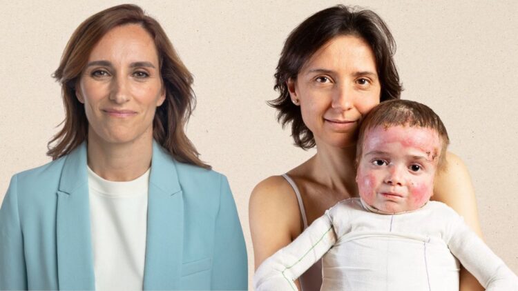 El Gobierno se compromete a traer a España el tratamiento para la Piel de Mariposa