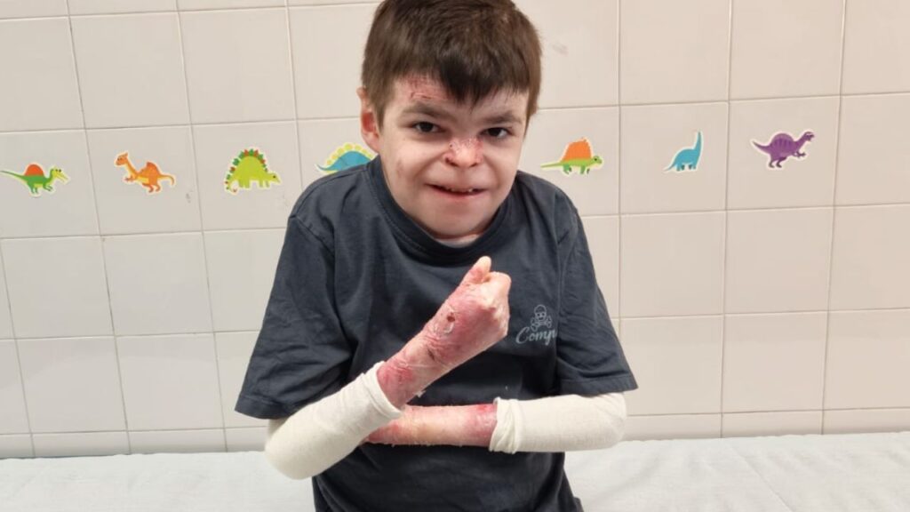 Leo, paciente sevillano con Piel de Mariposa