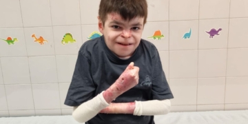 Leo, paciente sevillano con Piel de Mariposa