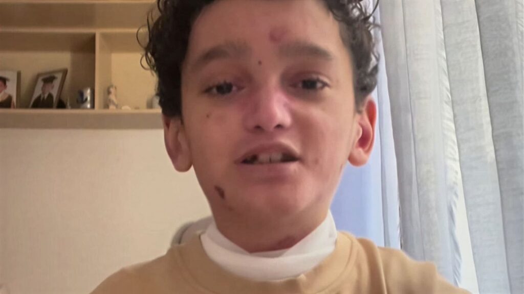 Mohamed, un pequeño con Piel de Mariposa, explica qué alimentos puede comer debido a la enfermedad