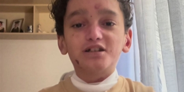 Mohamed, un pequeño con Piel de Mariposa, explica qué alimentos puede comer debido a la enfermedad