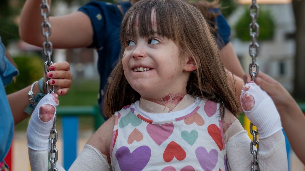 Victoria, niña cordobesa con Piel de Mariposa