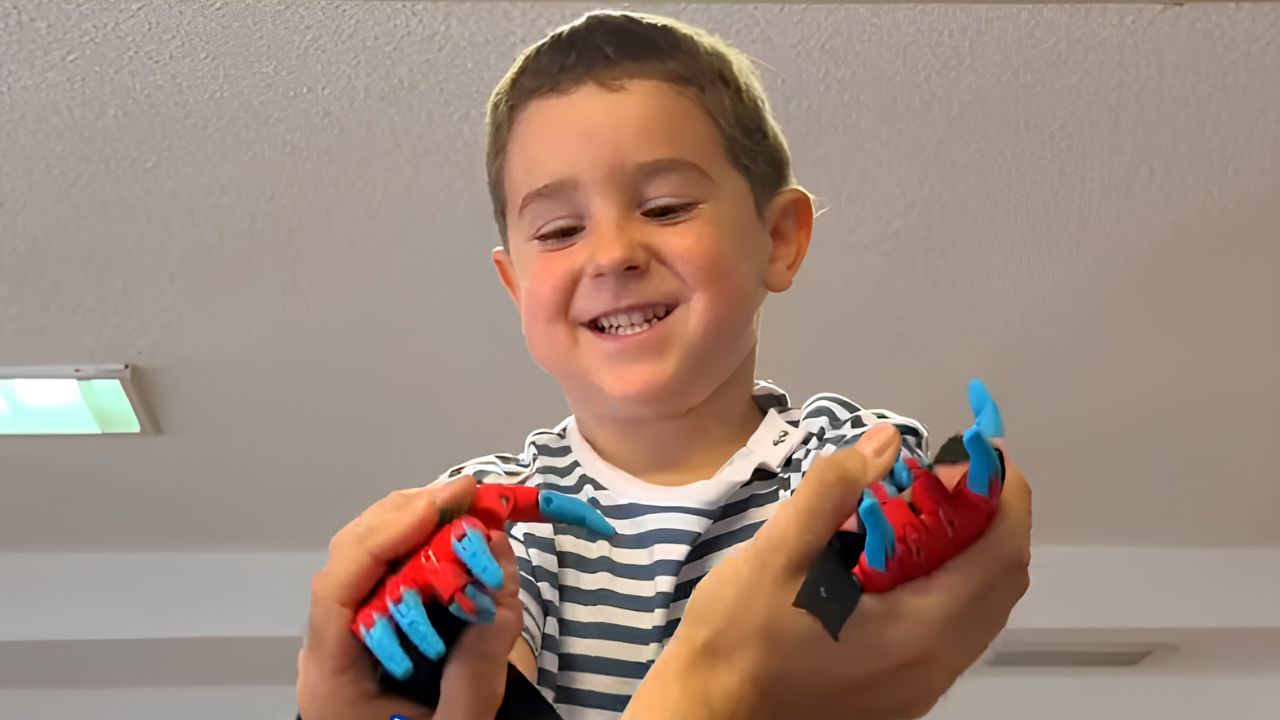 Mael recibe una prótesis de manos de 'Spiderman' de 'Ayudame 3D