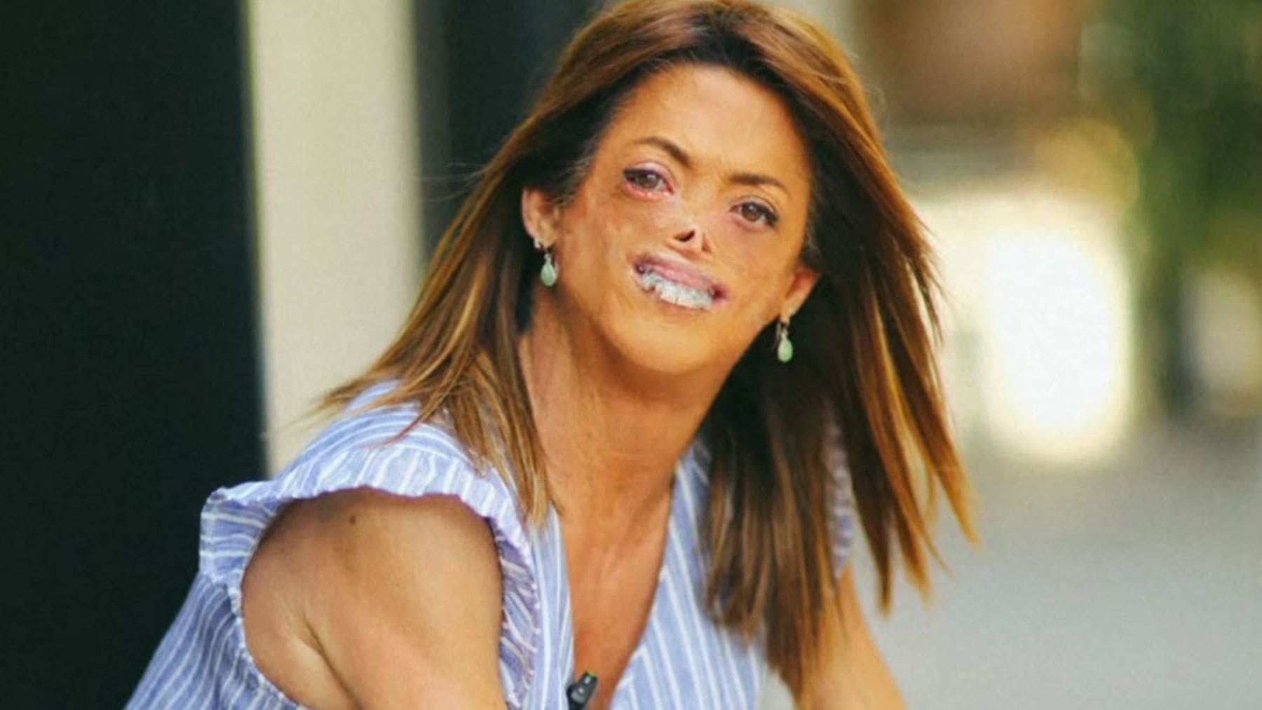 Fide Mirón, mujer española que convive con una Porfiria Eritropoyética Congénita de Günther (CEP)