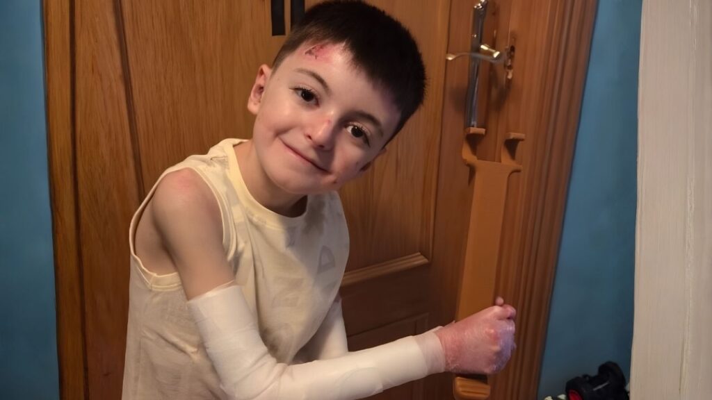 Adrián sigue sin poder acceder al tratamiento para la Piel de Mariposa: «Cada semana que pasa sin Vyjuvek es una semana de dolor»